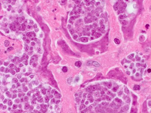 Examination of parasites in a person