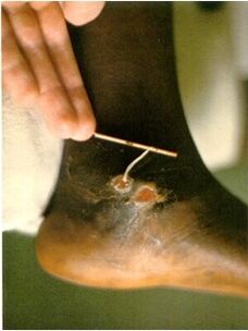 A Guinea worm extracted from the leg of a person suffering from dracunculosis