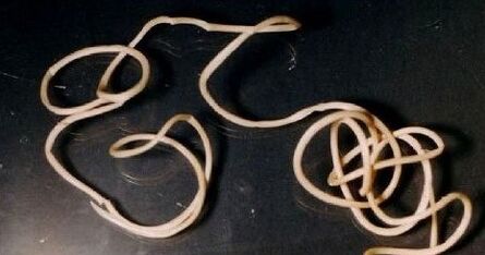 Guinean worm